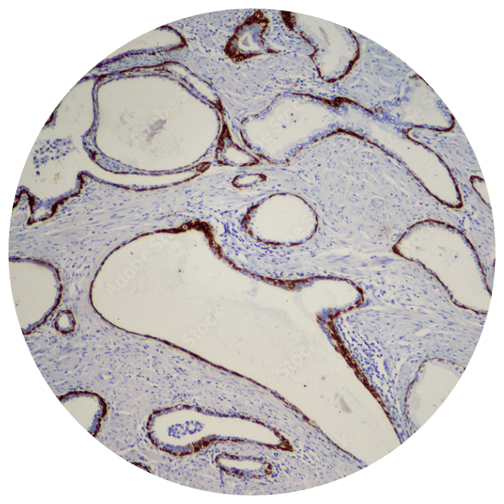 Cancer cells under a microscope